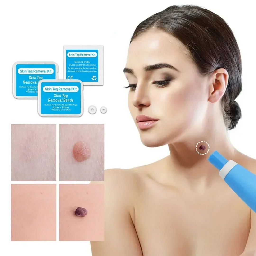 TagBand© Caneta Removedora de Verruga (Acrocordons) KIT COMPLETO - Remoção Rápida e Eficaz